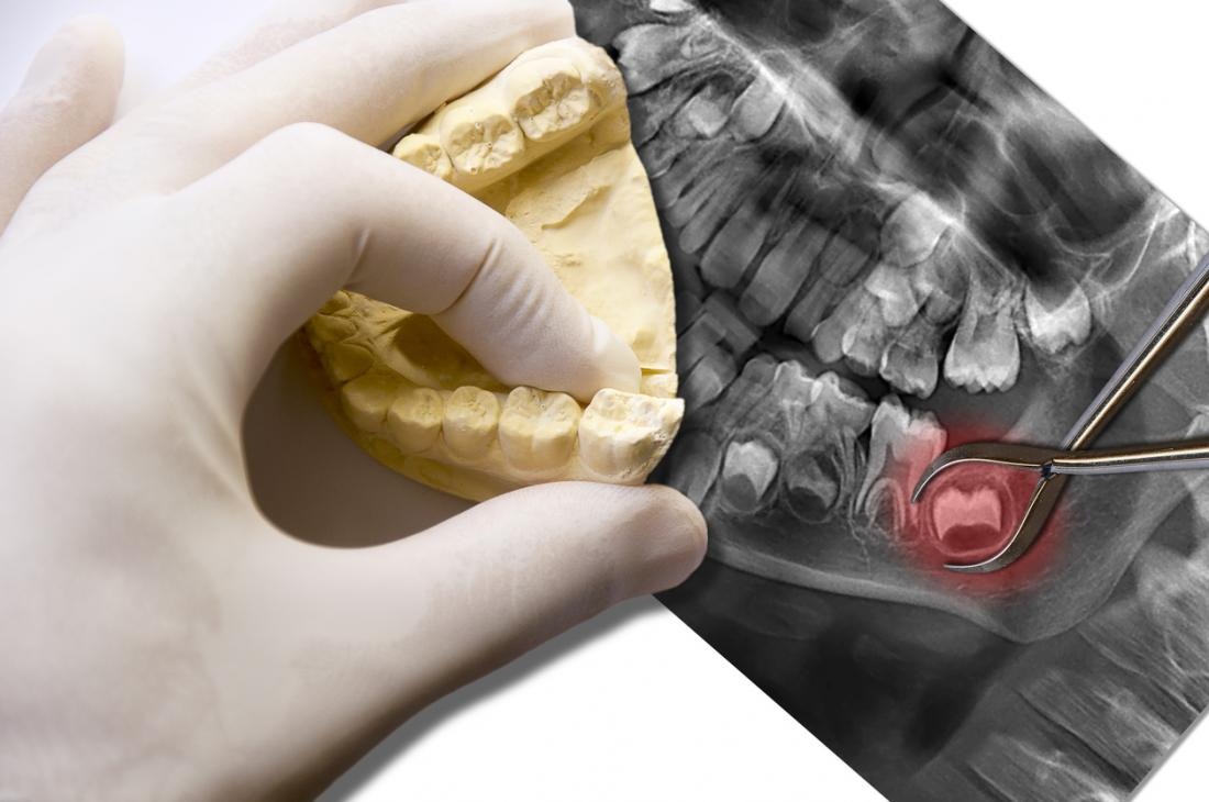 Wisdom Teeth Pain: What Causes It And What Can You Do About